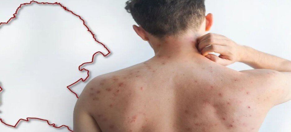 El estado de Coahuila se mantiene en alerta ante el sarampión