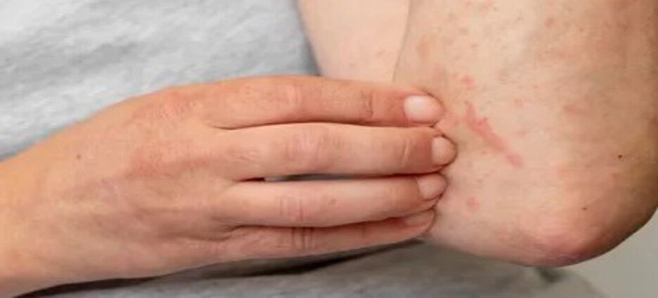 El sarampión en el estado de Coahuila, se registran ocho contagios y 132 casos sospechosos